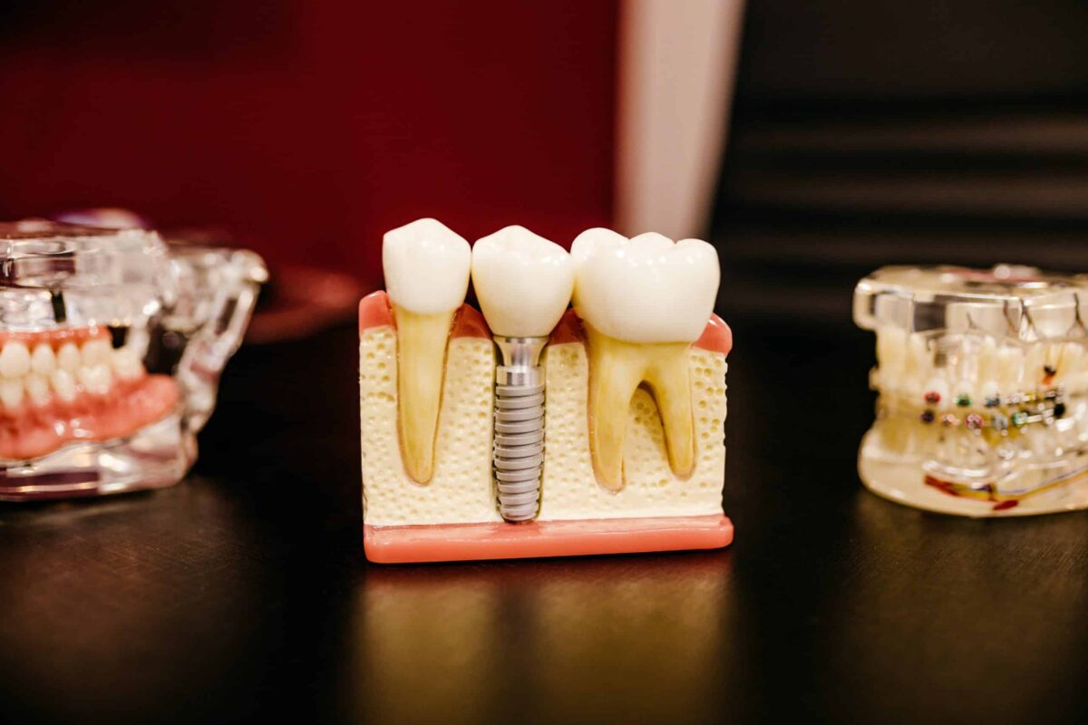 ¿Qué corona dental es mejor?